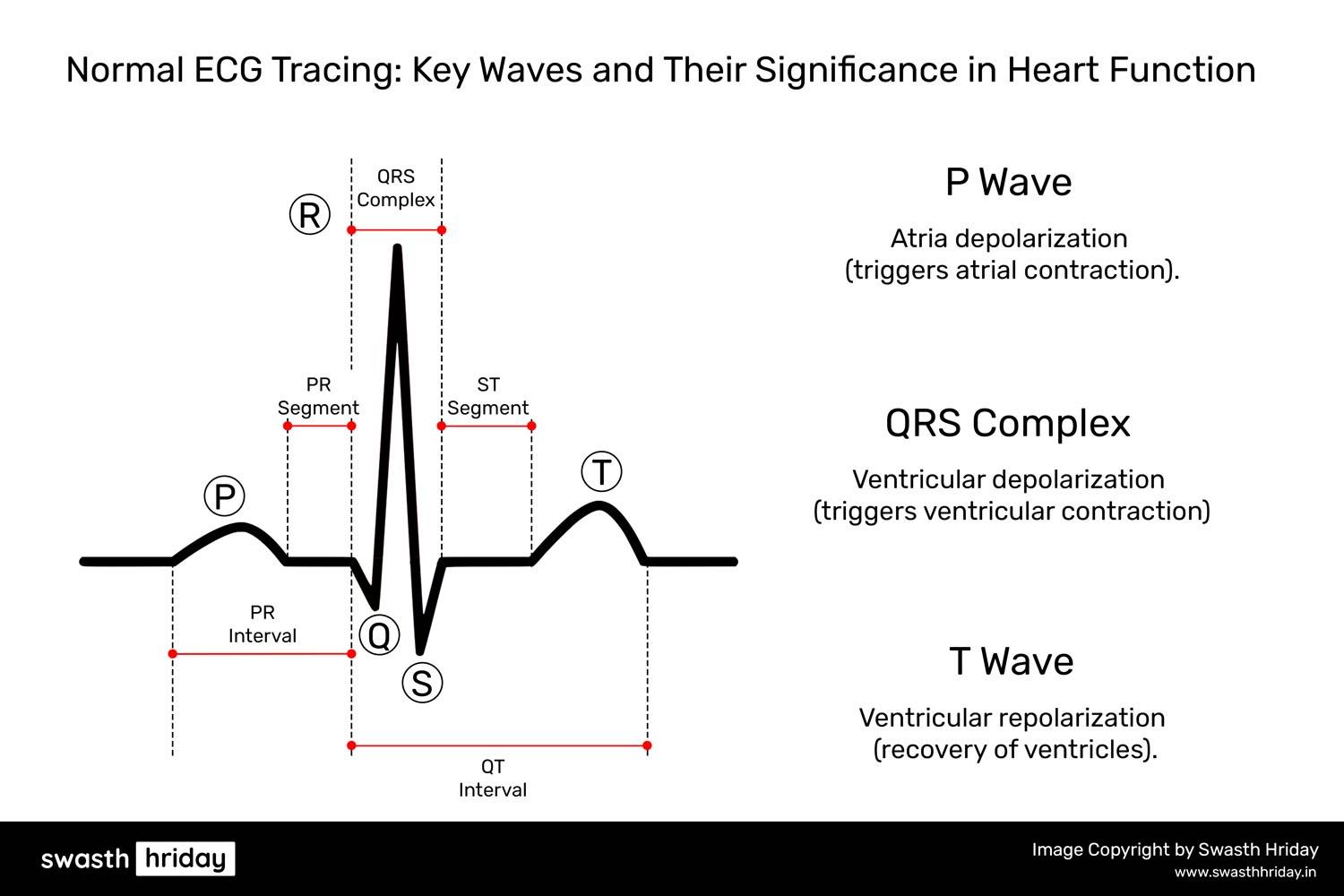 Common Abnormalities Found in an ECG and What They Mean
