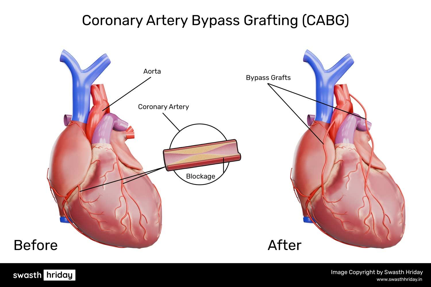 કોરોનરી આર્ટરી બાયપાસ ગ્રાફ્ટિંગ (CABG): શું અપેક્ષા રાખવી