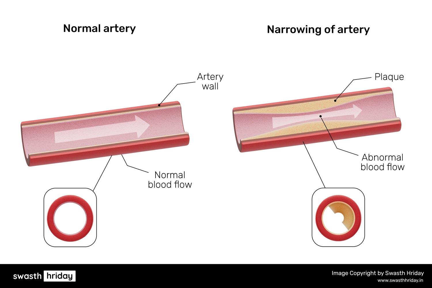 હૃદયની રચના અને કોરોનરી ધમનીઓ: કેવી રીતે તે હૃદયમાં રક્ત પુરું પાડે છે.