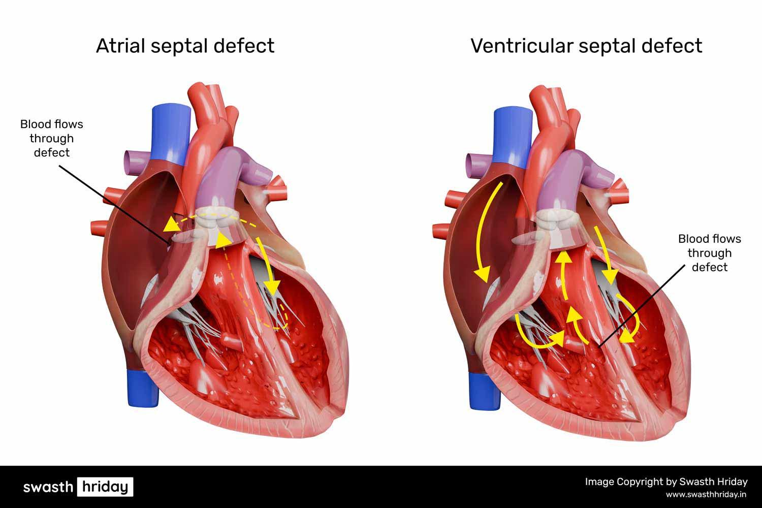 જન્મજાત હૃદય દોષના પ્રકાર: સાયનોટિક અને એ-સાયનોટિક