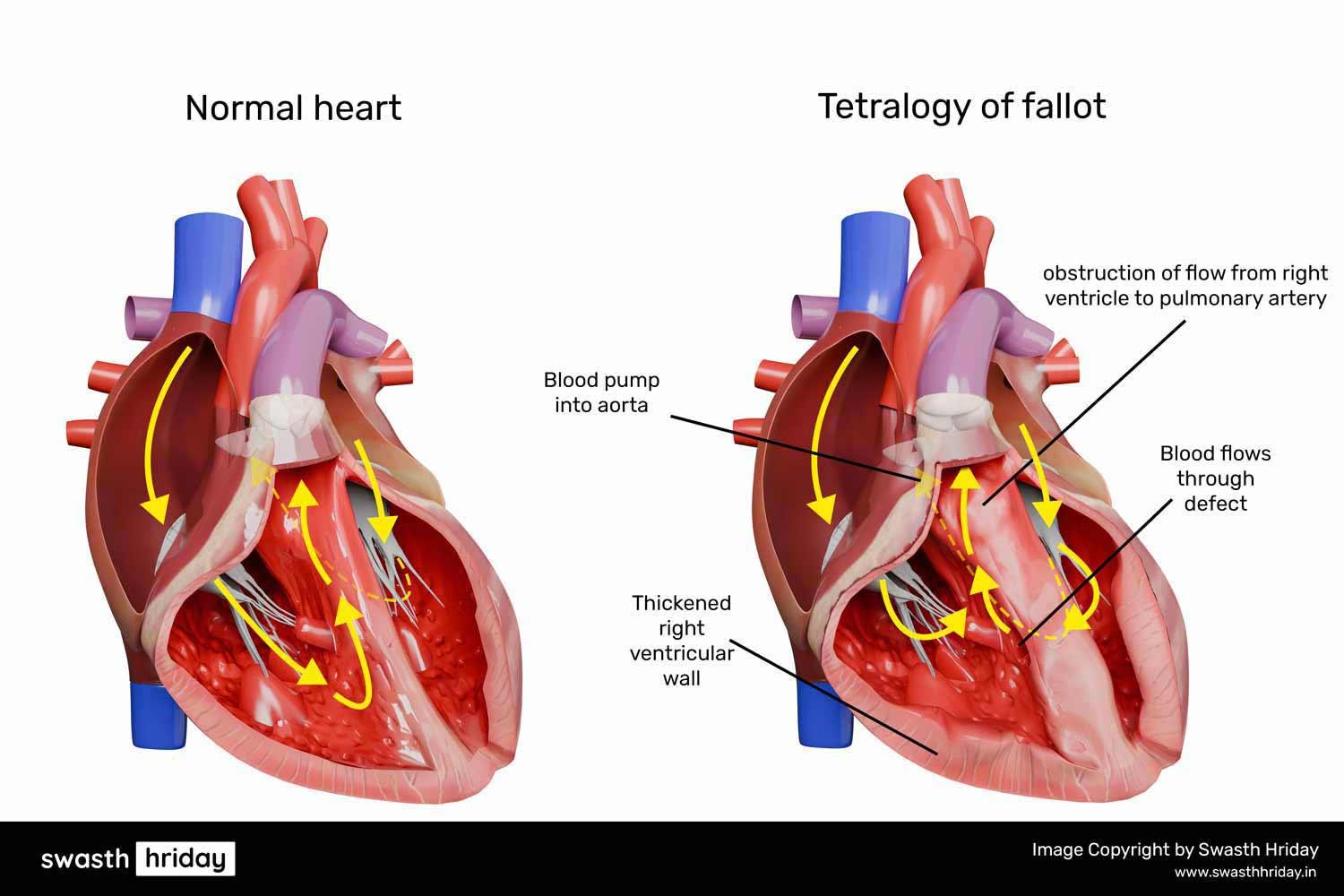 જન્મજાત હૃદય દોષના પ્રકાર: સાયનોટિક અને એ-સાયનોટિક