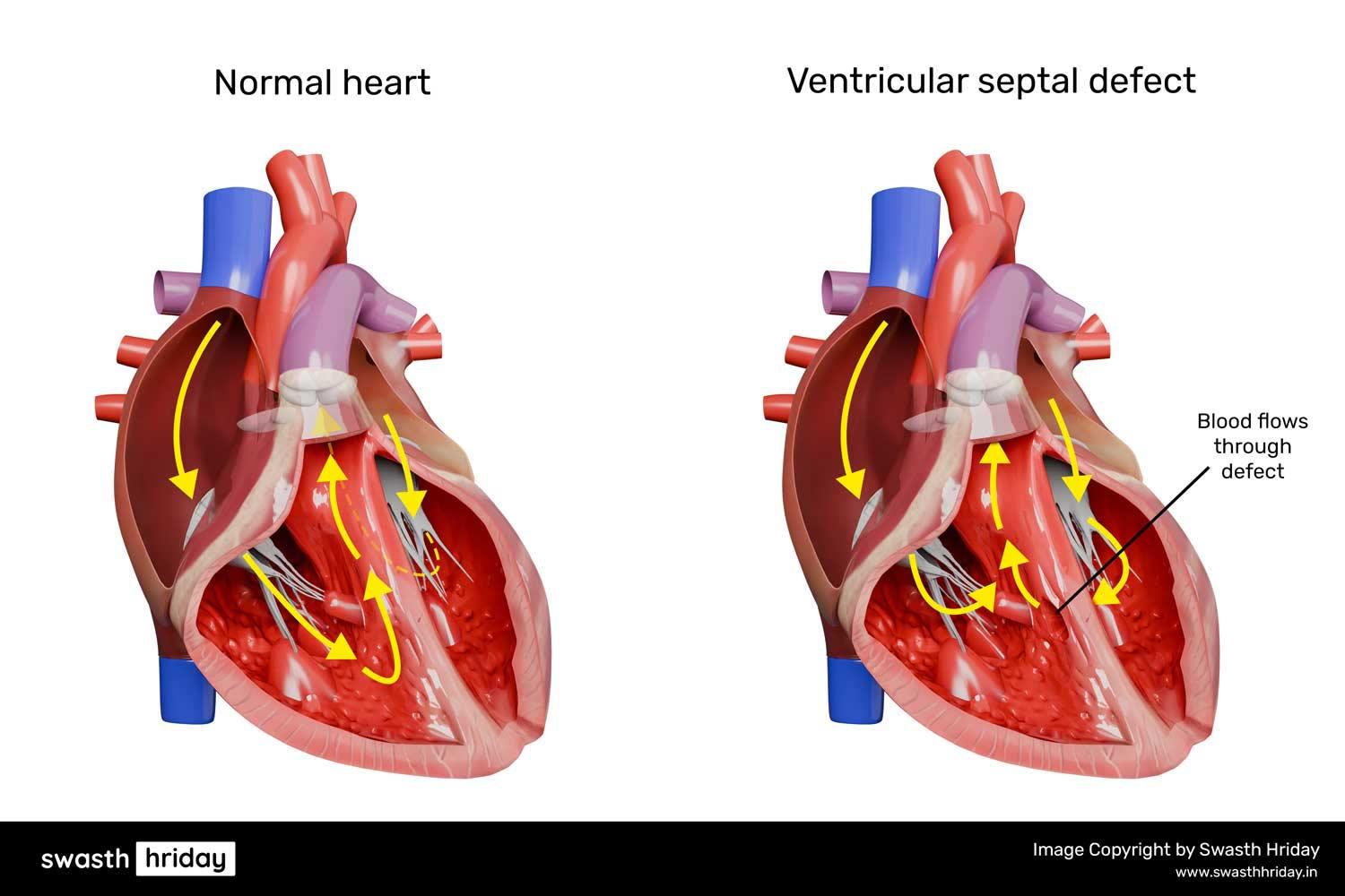 जन्मजात हृदय दोष के प्रकार: सायनोटिक vs ए-सायनोटिक