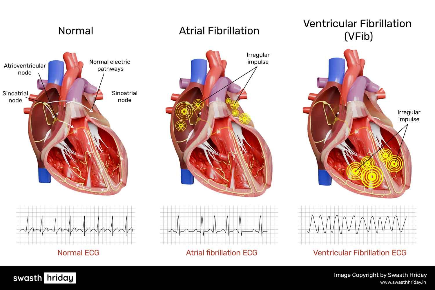 क्या एरिदमिया हृदय रोग का कारण बन सकती है? संबंध को समझें