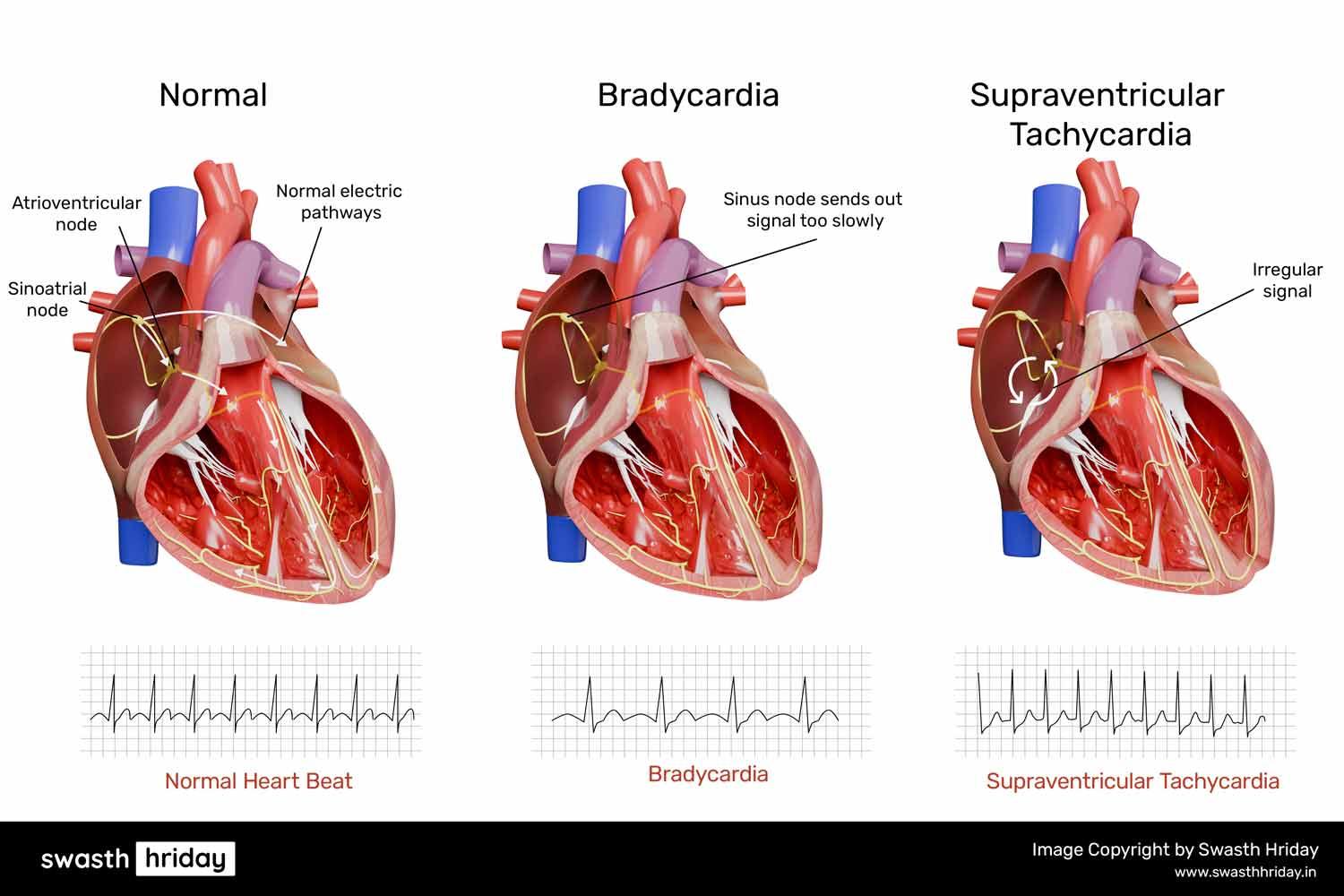 एरिदमिया क्या है? प्रकार, लक्षण और उपचार