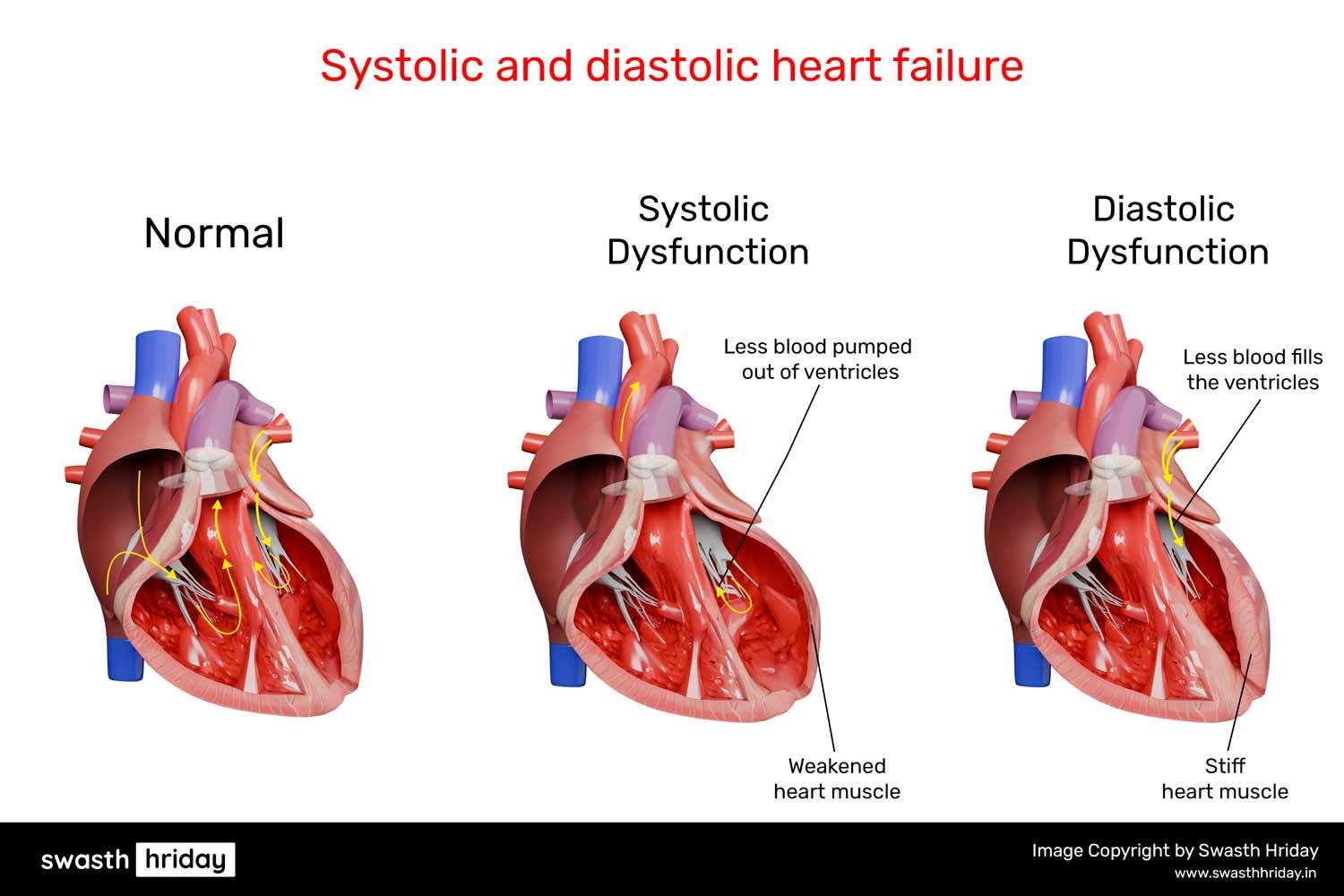 એરિધમિયા શું છે? પ્રકારો, લક્ષણો અને ઉપચાર