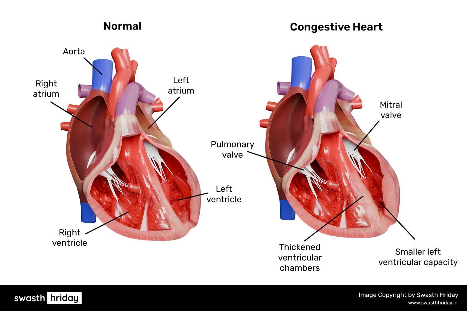 कंजेस्टिव हार्ट फेल्योर क्या है? कारण और उपचार