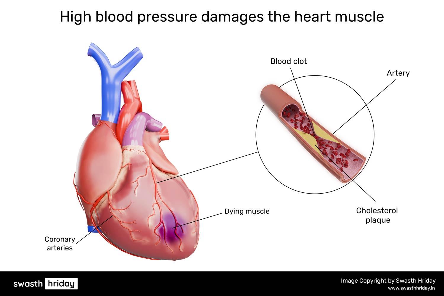कंजेस्टिव हार्ट फेल्योर क्या है? कारण और उपचार