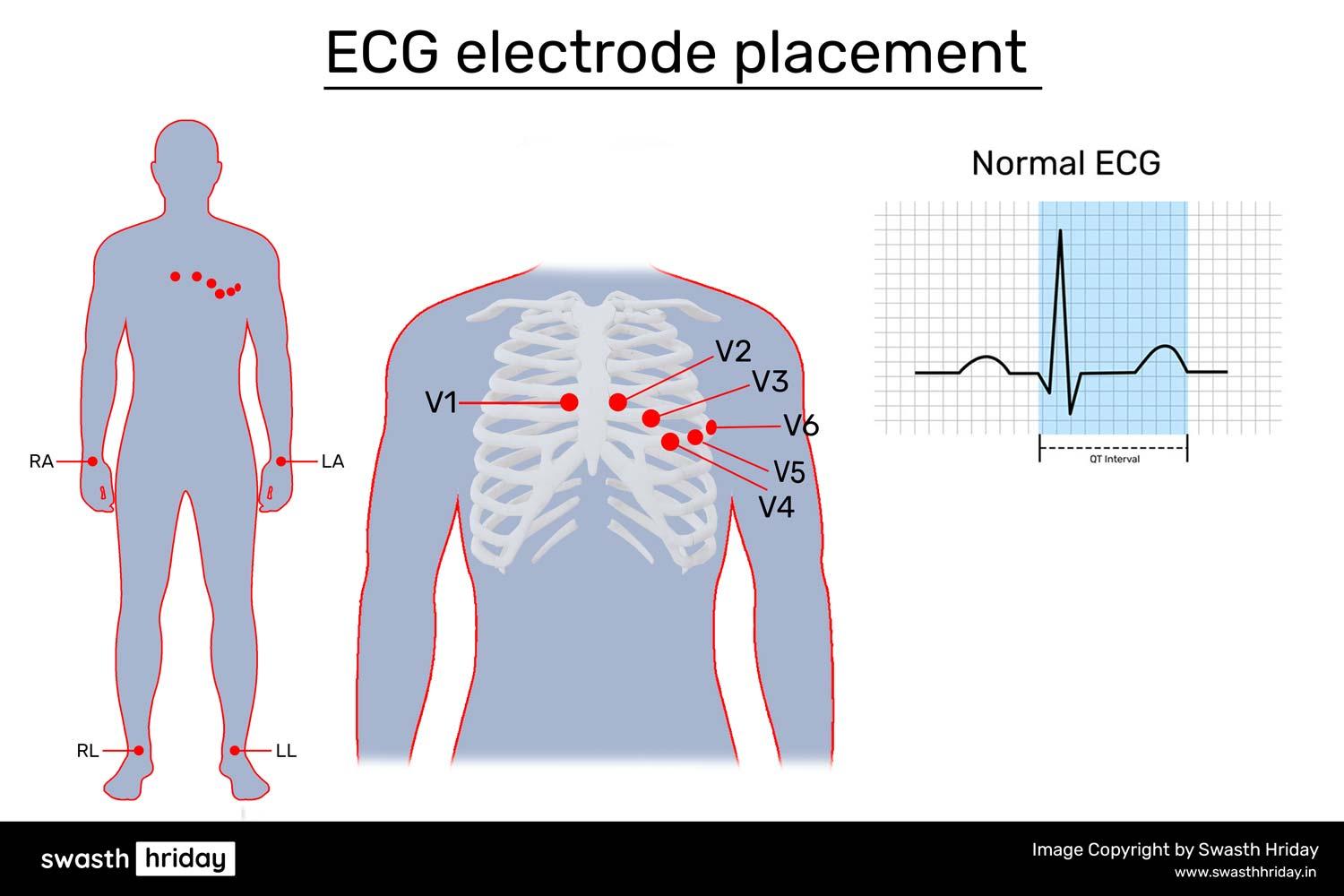 Will Heart Disease Show Up on an ECG? How Arrhythmias Are Diagnosed