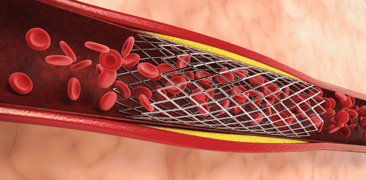 કોરોનરી આર્ટરી ડિસીઝના પ્રકારો: એક સંપૂર્ણ માર્ગદર્શિકા