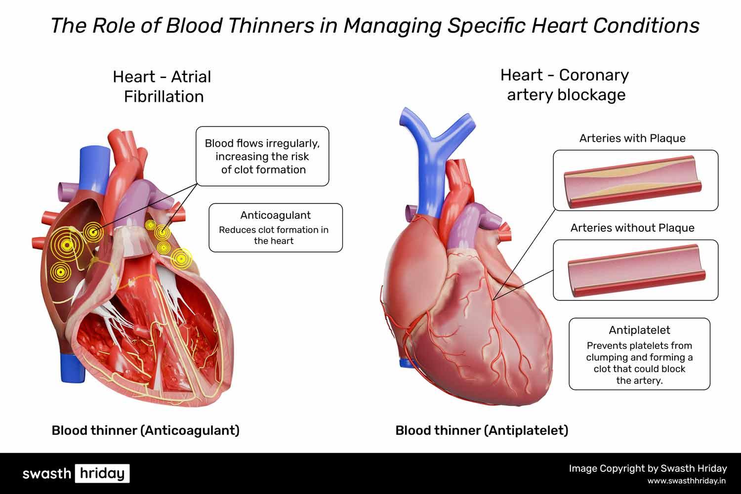 Blood Thinners: Reducing Heart Attack and Stroke Risk હૃદય રોગોના મેનેજમેન્ટમાં બ્લડ થિનર્સની ભૂમિકા