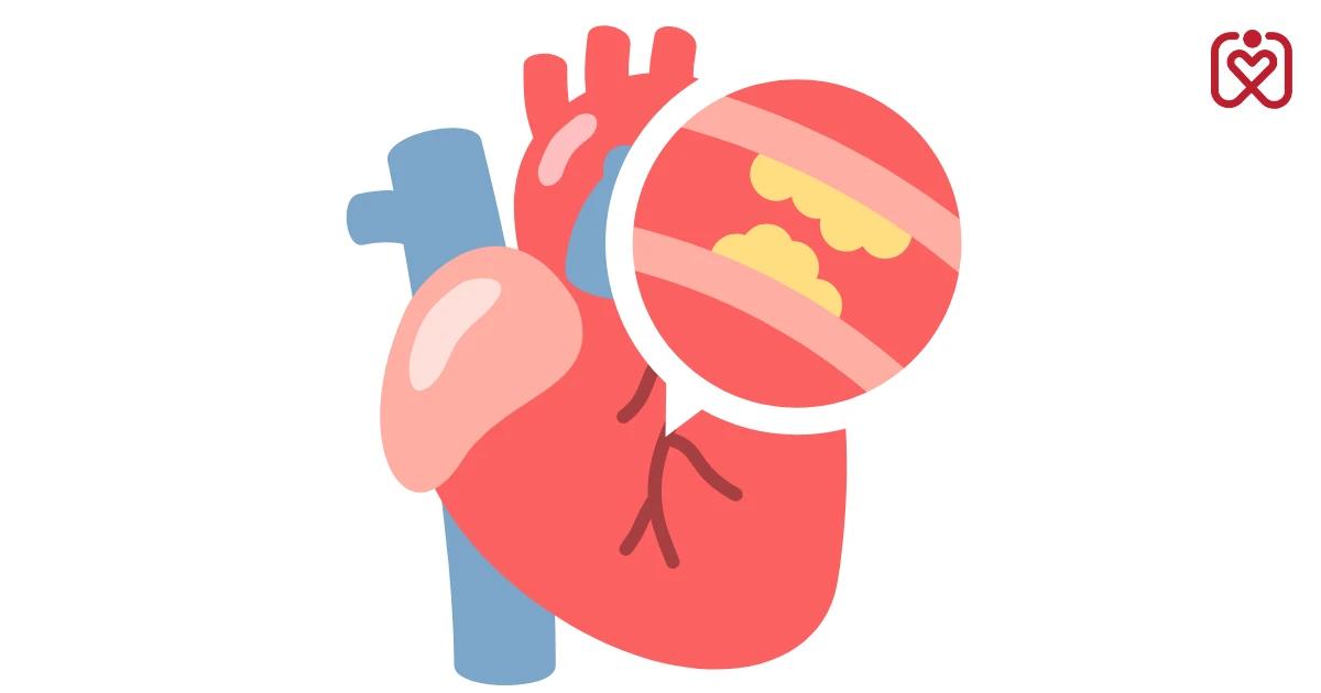 કોરોનરી આર્ટરી ડિસીઝના પ્રકારો: એક સંપૂર્ણ માર્ગદર્શિકા