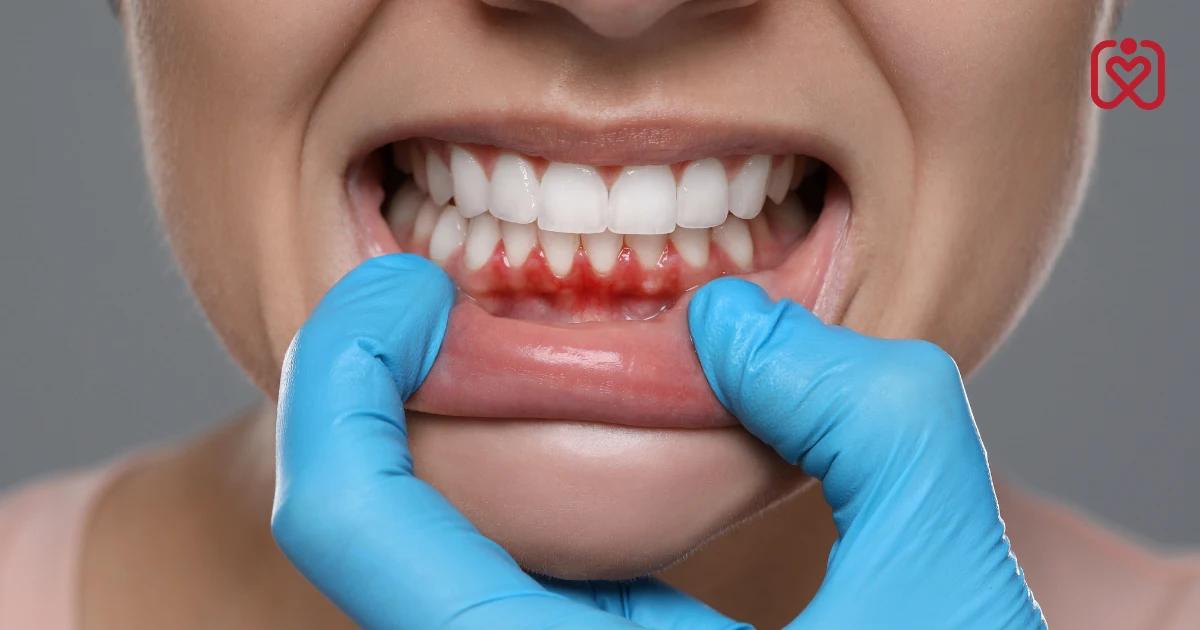 How Gum Disease Increases Heart Disease Risk